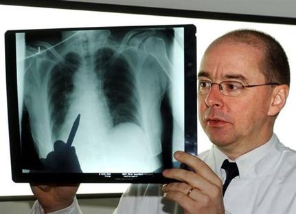 Ο καρκίνος του πνεύμονα προκαλεί περισσότερους θανάτους από οποιαδήποτε άλλη μορφή καρκίνου (Φωτογραφία: ΑΠΕ)